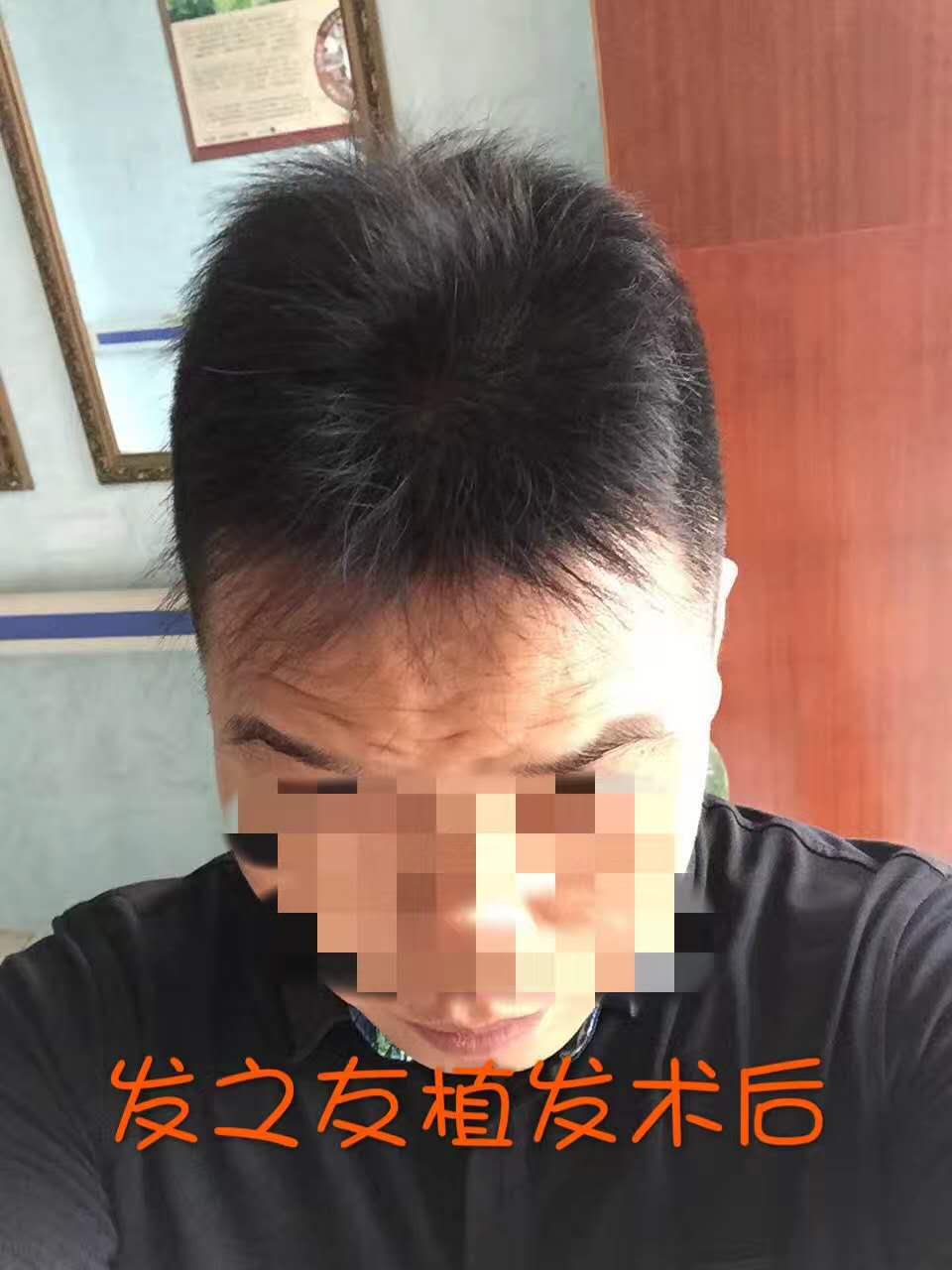 广西脱发治疗多少钱/发之友